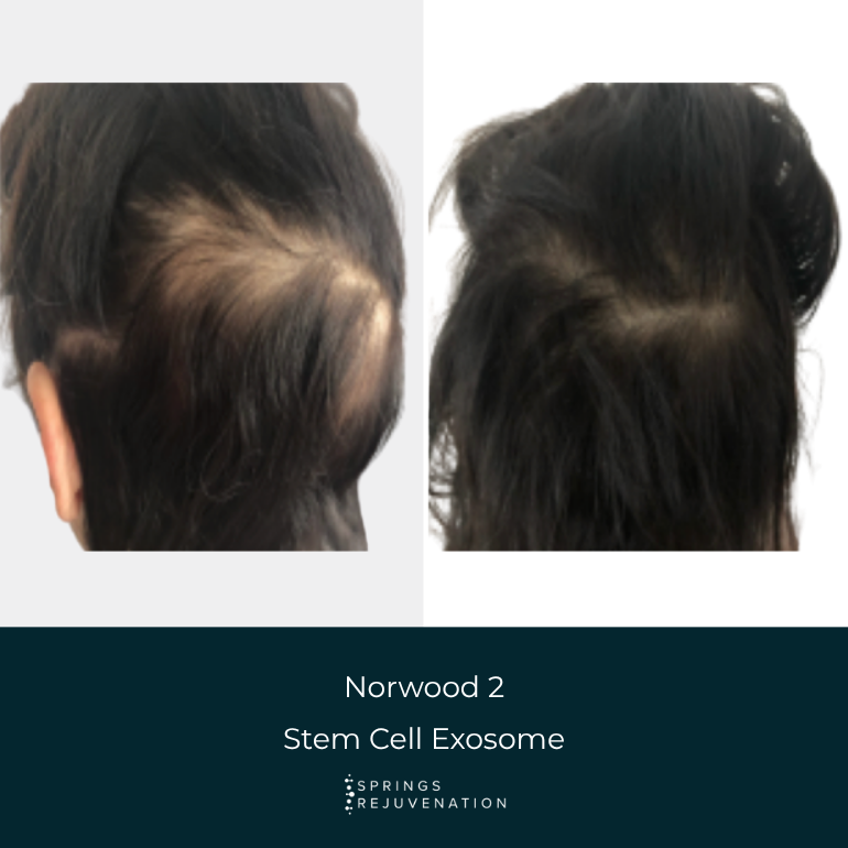 Norwood 2 Stem Cell Exosome